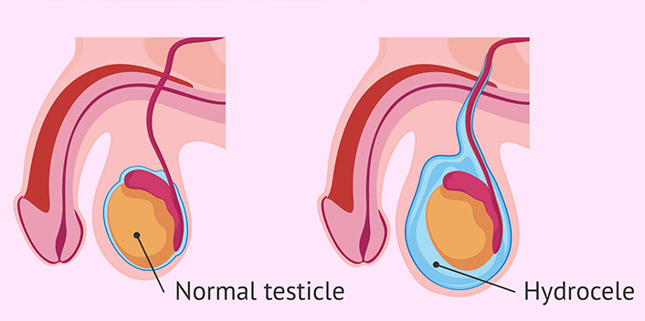 Hydrocele
