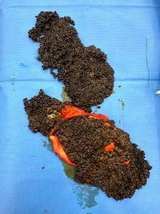 Advanced gallstones treatment in Ahmedabad