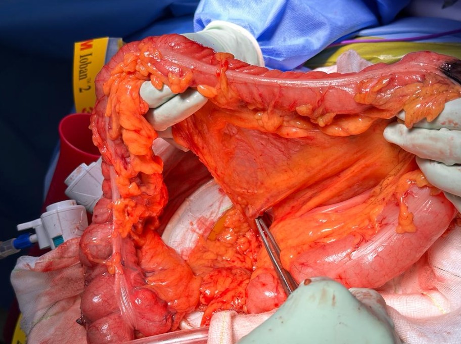 colorectal
