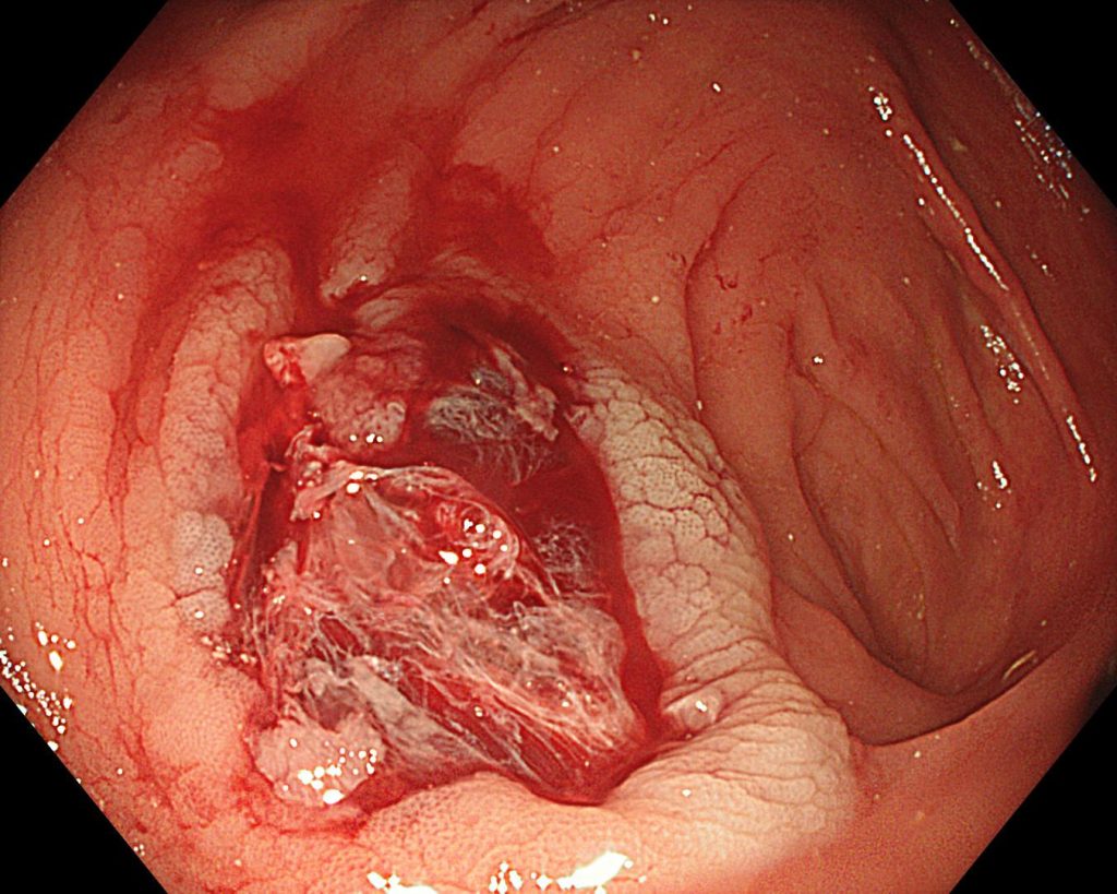 gi endoscopy 2