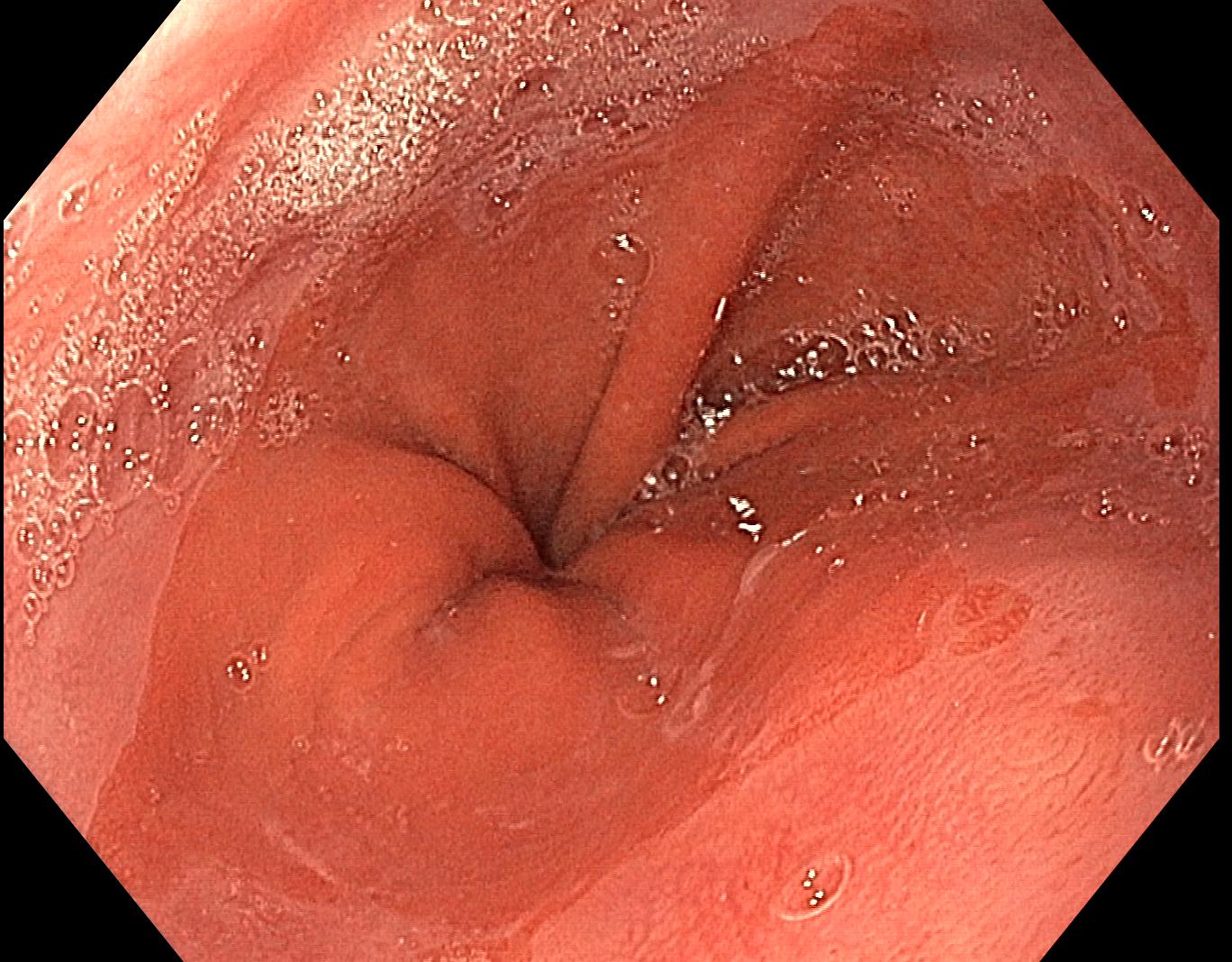 gi endoscopy