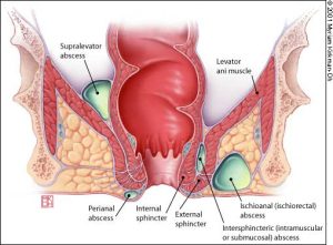 Laser Hemorrhoid Surgery