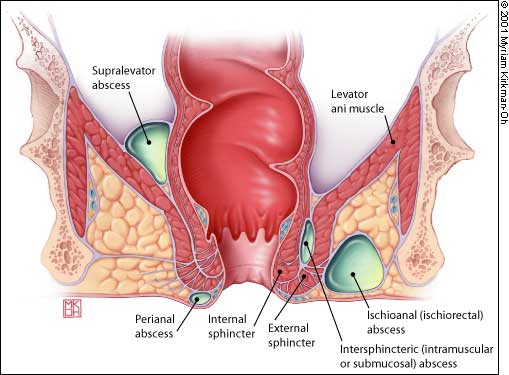 Laser Hemorrhoid Surgery