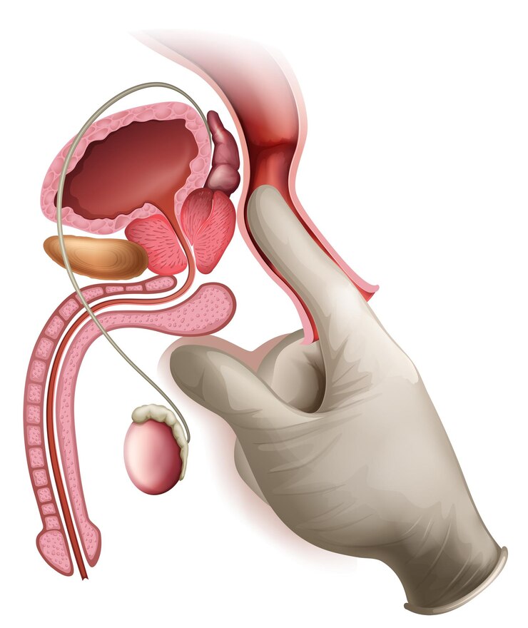 prostate cancer