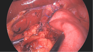 Advanced antireflux surgery in Ahmedabad