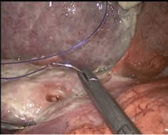 Gastrointestinal Perforation