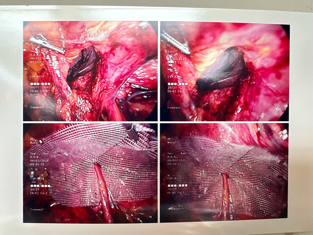 Hernia photos 1
